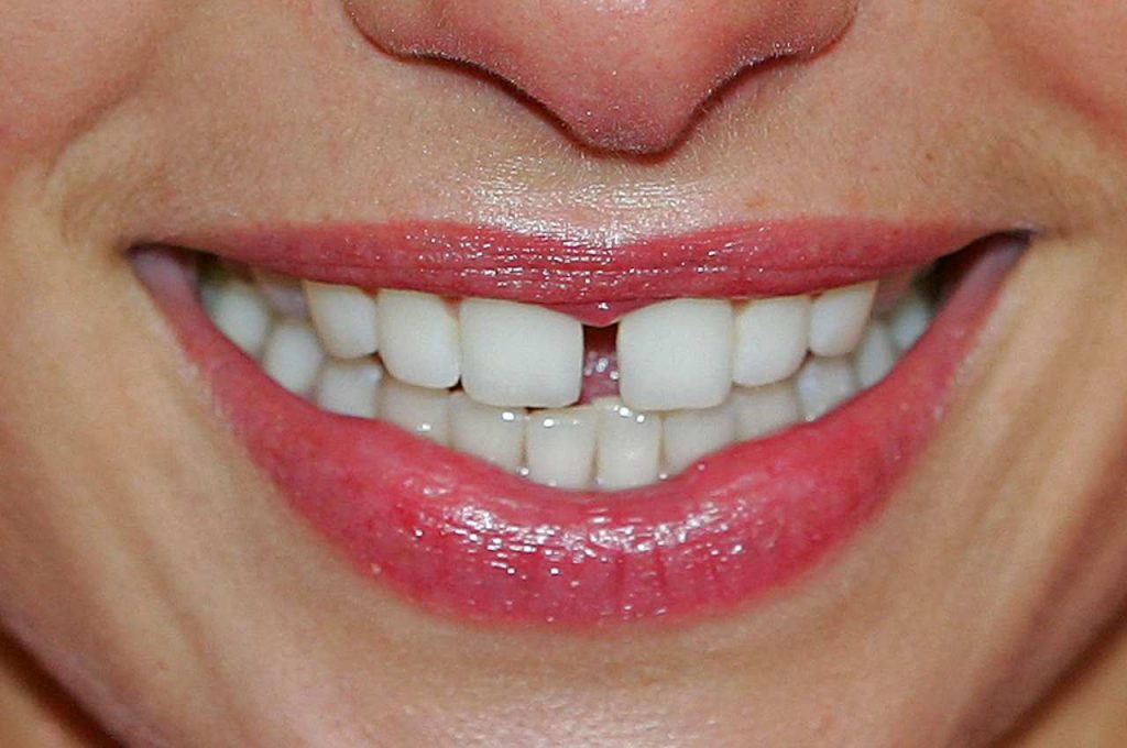 Come sbiancare i denti grazie a qualche semplice rimedio naturale