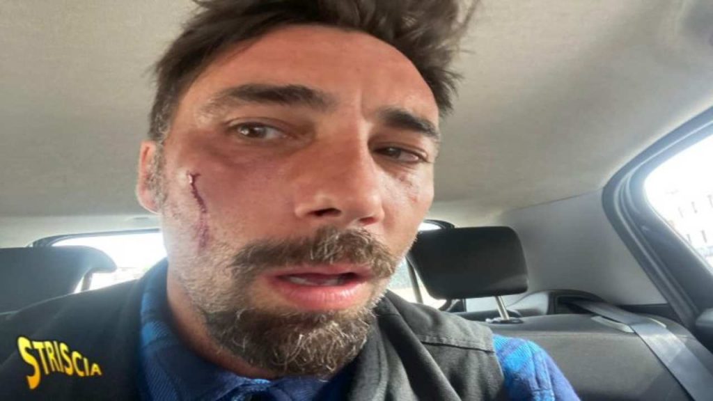 Vittorio Brumotti com’è ridotto il suo viso dopo l’aggressione | La foto parla chiaro